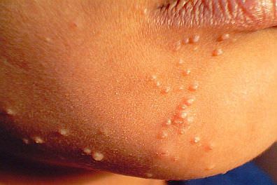 Child with small bumps on their face caused by molluscum contagiosum virus