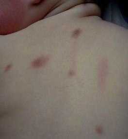 child's back has urticaria pigmentosa