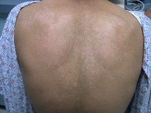 child's back with tinea versicolor