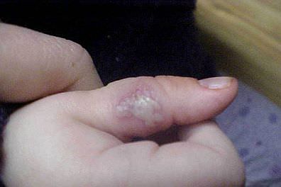 child with blisters on their hand