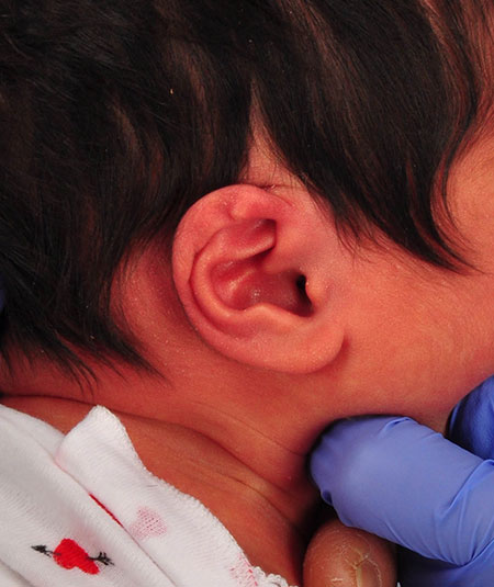 baby with helical kinking of the ear before ear molding treatment