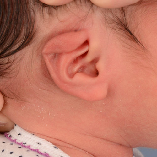 infant's ear before ear molding and reconstruction treatment