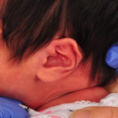 baby with helical kinking before ear molding treatment