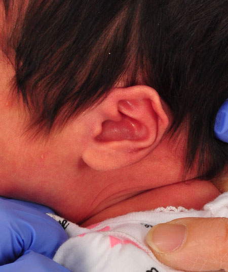 baby with helical kinking of the ear before ear molding treatment