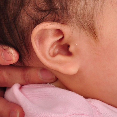 infant's ear after undergoing ear molding and reconstruction
