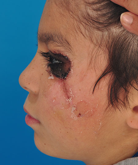 Before nevus removal by plastic surgery