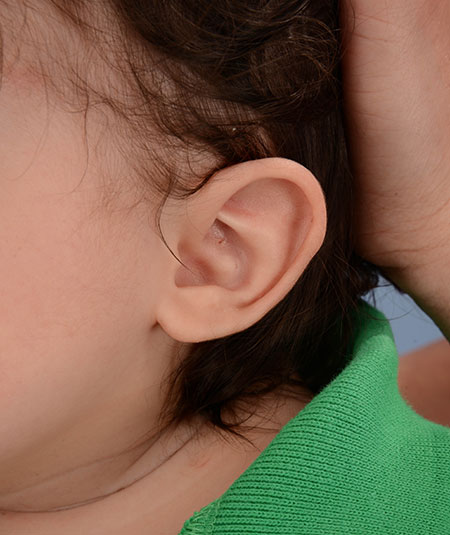 Baby's ear after undergoing ear molding treatment for a Helical rim deformity