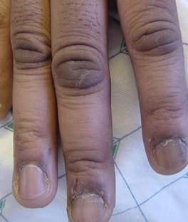Child fingers with acanthosis nigricans