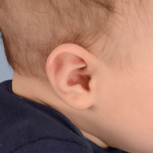 Baby with Stahl's ear before getting ear molding treatment