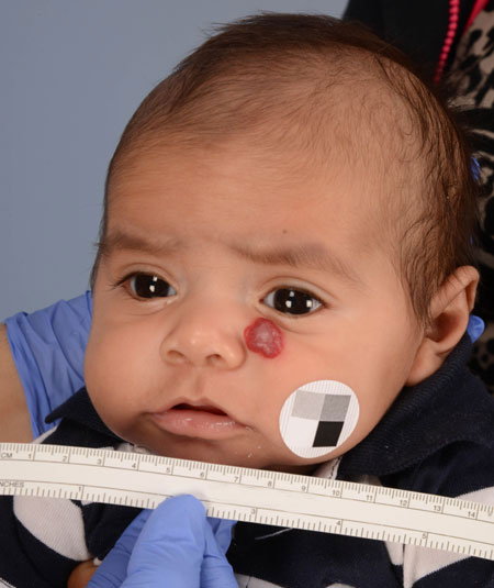 before photo baby boy with hemangioma under his eye