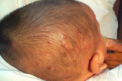 Infant scalp with folliculitis