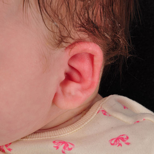 Baby's ear after undergoing ear molding treatment for constricted ear
