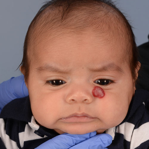 before picture of infant patient with vascular anomaly