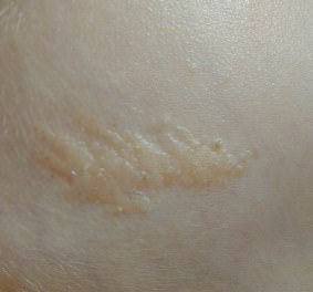 image of skin with nevus sebaceous