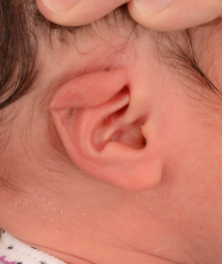 infant's ear before ear molding