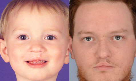 Cleft and Craniofacial Before and After Photos - Stanford Medicine  Children's Health