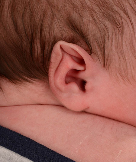 Stahl's ear in an infant before receiving ear molding treatment