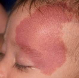 Child's face with a port wine stain on the left side of face