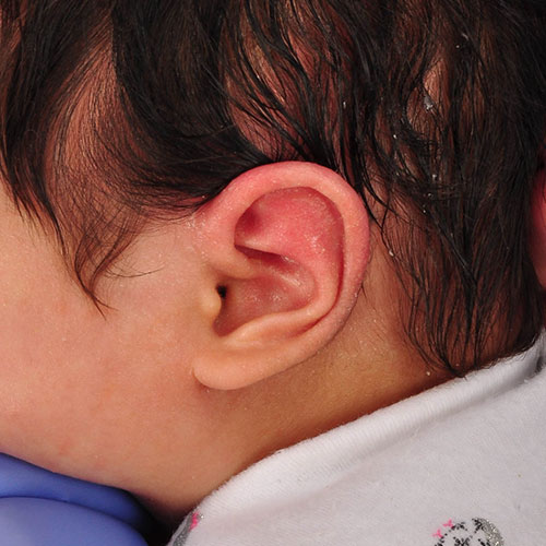 baby after ear molding treatment for helical kinking 