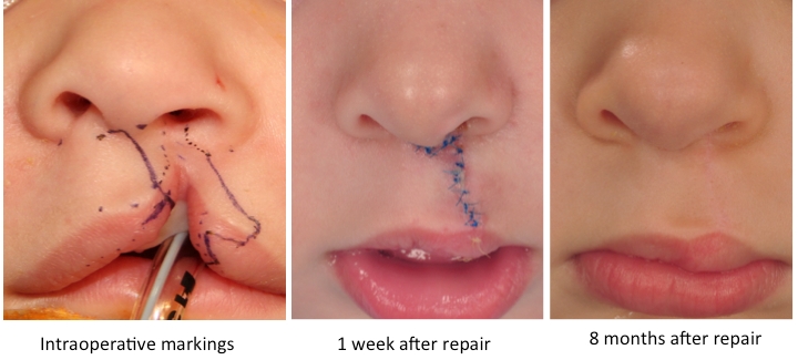 unilateral cleft lip repair figures