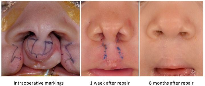 bilateral cleft lip repair figures