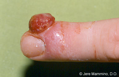 Pyogenic Granuloma on the tip of finger