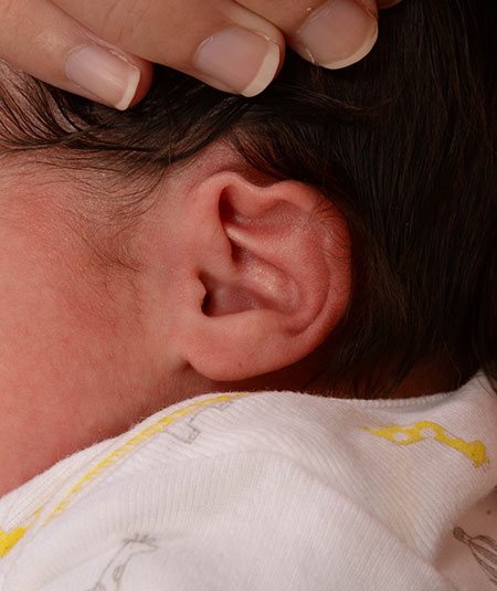 Helical rim deformity in an a baby's ear before ear molding treatment