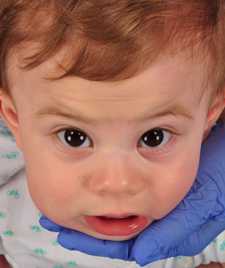baby after strip craniectomy for metopic craniosynostosis