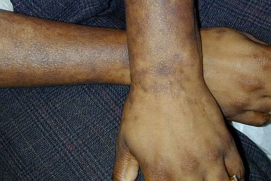 Arms with Mycosis Fungoides