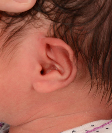 infant's ear before ear molding