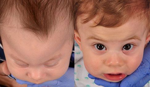 before and after of baby boy with metopic craniosynostosis