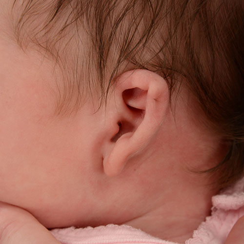 baby with constricted ear before ear molding treatment