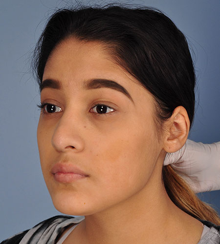 girl after rhinoplasty after nasal trauma