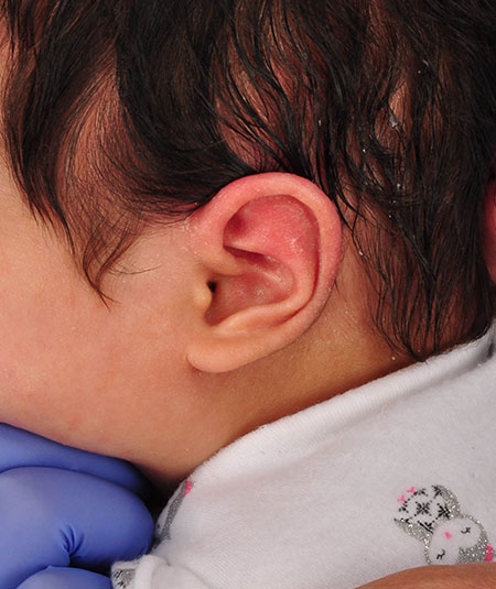 baby after ear molding treatment for helical kinking