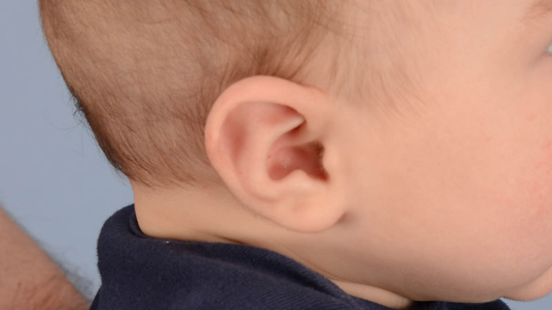 baby with Stahl's ear after treatment with ear molding