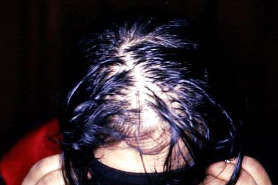 scalp with telogen effluvium