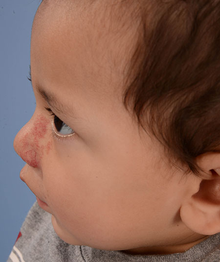 after photo of boy with nasal hemangioma removed