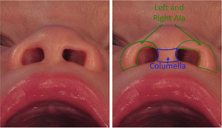 pediatric cleft lip