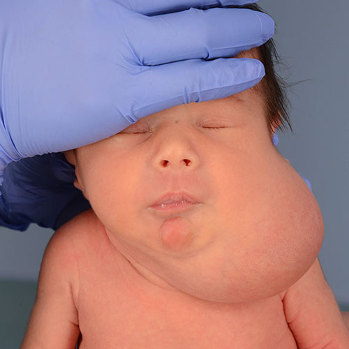 Infant before removal of venolymphatic malformation 