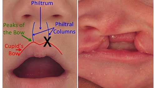 formation of a normal lip compared with a case of unilateral cleft lip
