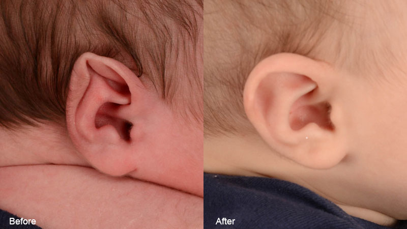 A baby's ear before and after Stahl's ear treatment with ear molding