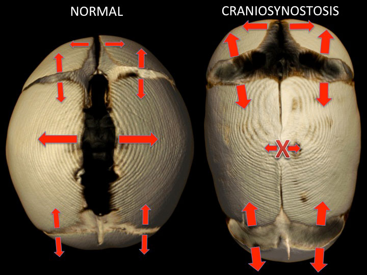 pictures of a normal skull and one with craniosynostosis