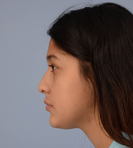 girl before rhinoplasty after nasal trauma