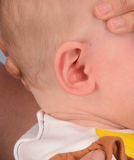 infant's ear after ear molding and reconstruction
