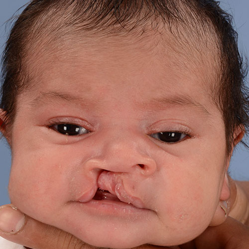before unilateral cleft lip and palate 