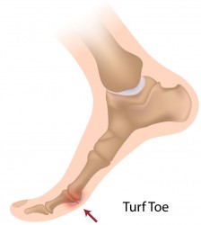 The symptoms of turf toe can include pain in the toe joint, swelling or a “popping” sound when the toe is flexed.