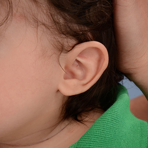 Baby's ear after undergoing ear molding treatment for a helical rim deformity
