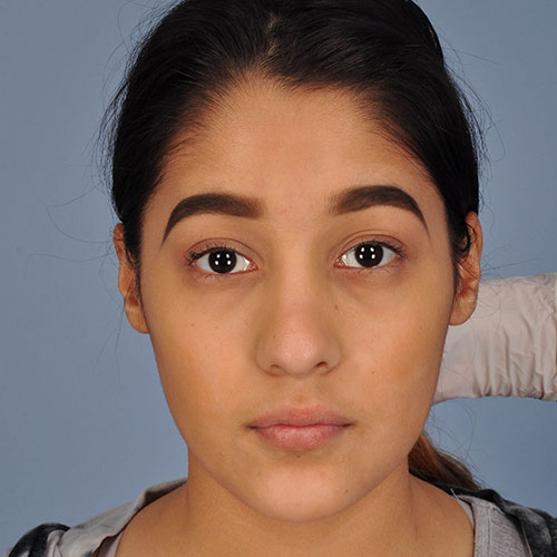 girl after rhinoplasty to correct nasal trauma