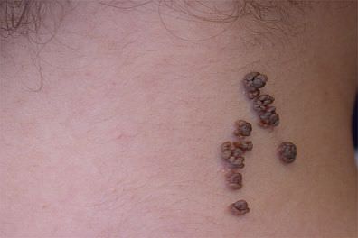 Back of child's neck with linear epidermal nevus