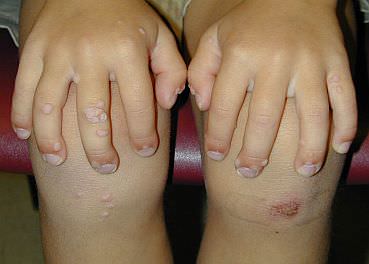 child with warts on their arms and legs